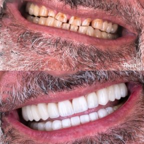 Vorher-nachher-Ergebnis Zahnkronen bei SmileBox Dental Clinic - Thonglor, Sukhumvit