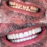 Vorher-nachher-Ergebnis Zahnkronen bei SmileBox Dental Clinic - Thonglor, Sukhumvit