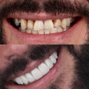 Vorher-nachher-Ergebnis Kroneninstallation bei SmileBox Dental Clinic - Thonglor, Sukhumvit