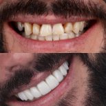 Vorher-nachher-Ergebnis Kroneninstallation bei SmileBox Dental Clinic - Thonglor, Sukhumvit
