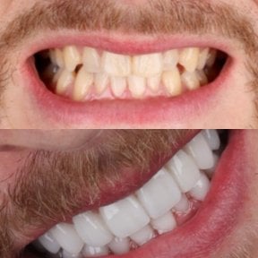 Vorher-nachher-Ergebnis Zahnkronen bei SmileBox Dental Clinic - Thonglor, Sukhumvit