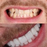 Vorher-nachher-Ergebnis Zahnkronen bei SmileBox Dental Clinic - Thonglor, Sukhumvit