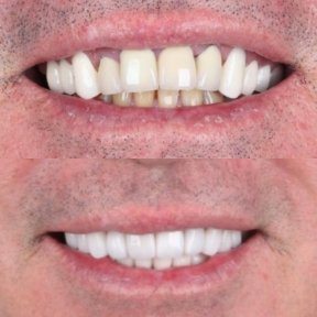 Vorher-nachher-Ergebnis Zahnkronen bei SmileBox Dental Clinic - Thonglor, Sukhumvit