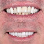 Vorher-nachher-Ergebnis Zahnkronen bei SmileBox Dental Clinic - Thonglor, Sukhumvit