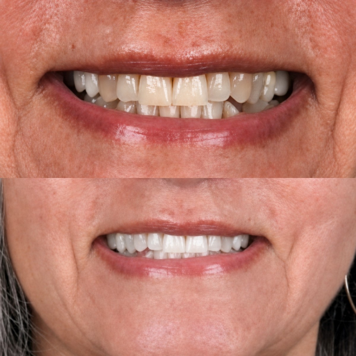 Resultado antes y después de blanqueamiento dental láser en SmileBox Dental Clinic - Thonglor, Sukhumvit