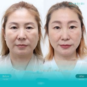 Forehead lift before and after results at Wansiri Hospital, visible rejuvenation and lift