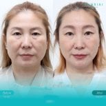 Forehead lift before and after results at Wansiri Hospital, visible rejuvenation and lift