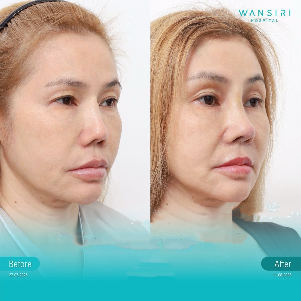 Resultados de lifting de frente antes y después en Wansiri Hospital, rejuvenecimiento visible