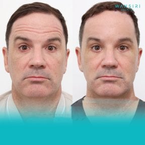 Forehead lift before and after results at Wansiri Hospital, visible smoother forehead lines