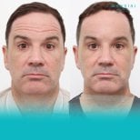 Forehead lift before and after results at Wansiri Hospital, visible smoother forehead lines