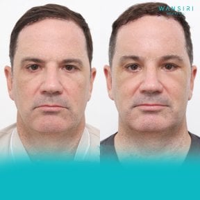 Forehead lift before and after results at Wansiri Hospital, visible brow elevation improvement