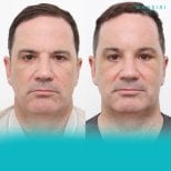 Forehead lift before and after results at Wansiri Hospital, visible brow elevation improvement