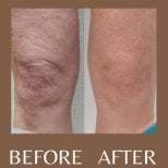 Cryolipolysis before and after results at ID Clinic Bangkok, smoother knee contour improvement