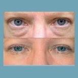 Before and after blepharoplasty results at ID Clinic Bangkok, eyelid correction improvement