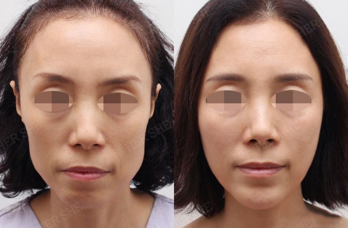 Resultados de lipofilling facial antes y después en HERSHE Plastic Surgery Korea, mayor volumen