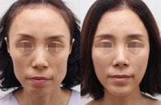 Before and after facial lipofilling results at HERSHE Plastic Surgery Korea, improved facial volume