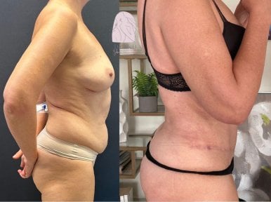 Before and after Vaser 3 areas plus tummy tuck results at Dr. MED – visible body contouring