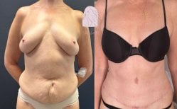 Before and after Vaser 3 areas plus tummy tuck results at Dr. MED, body contour improvement