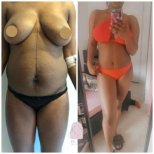 Before and after Vaser 3 areas plus tummy tuck results at Dr. MED – body contour improvement