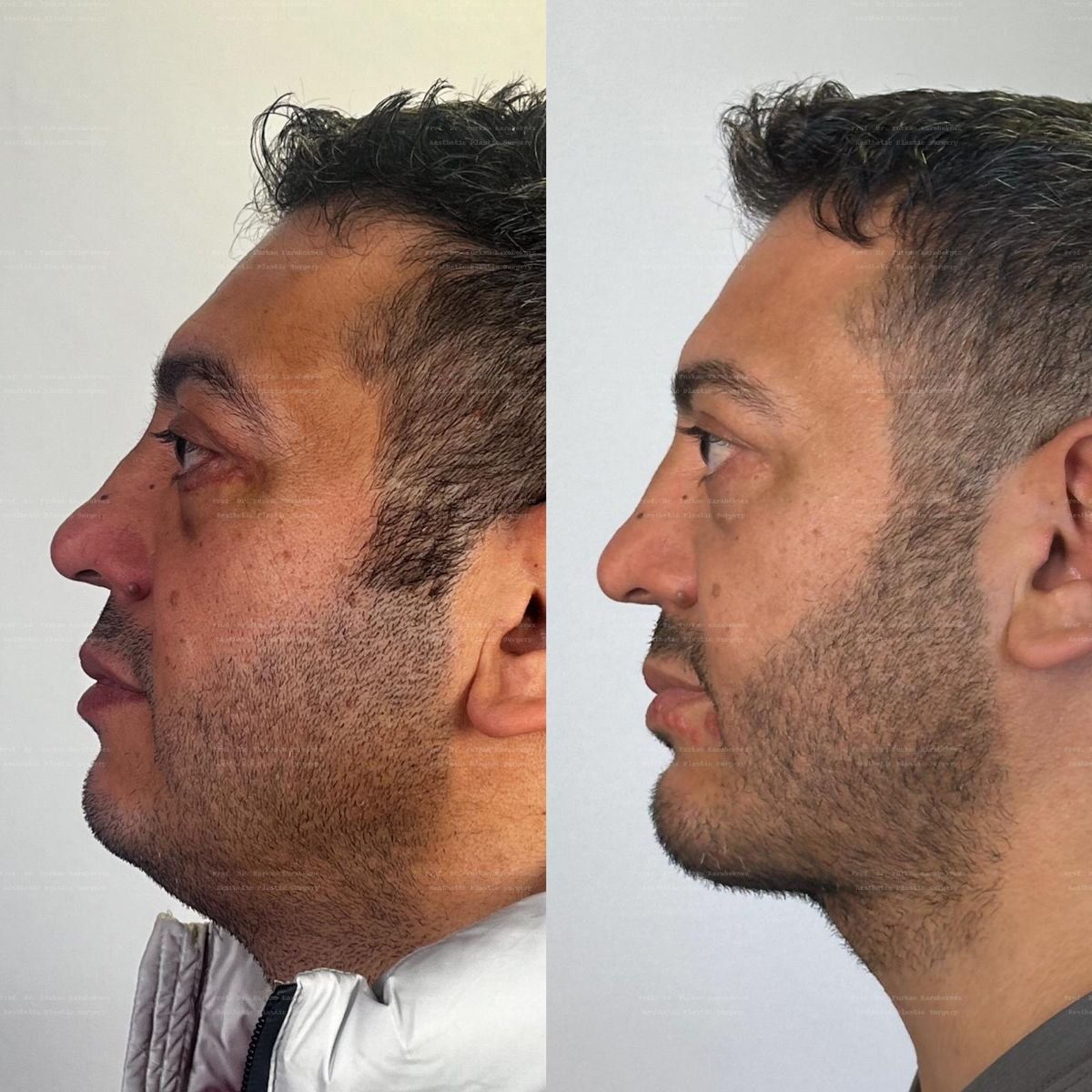 Resultados antes y después de implante de mentón en Prof. Furkan Karabekmez's Aesthetic Surgery Clinic