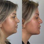 Vorher-nachher-Ergebnis Kinnimplantat bei Prof. Furkan Karabekmez's Aesthetic Surgery Clinic