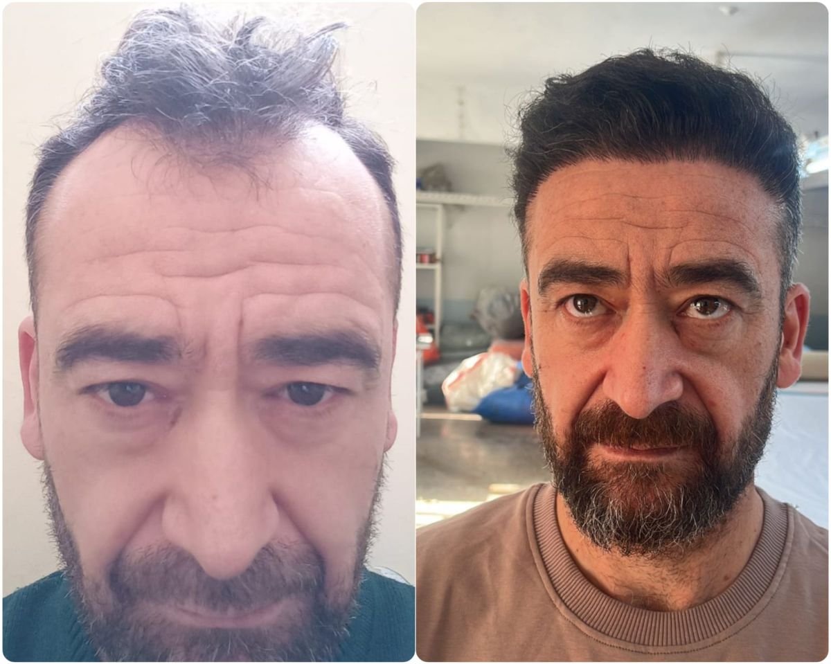 Resultados de trasplante capilar antes y después en Liv Bona Dea Hospital Baku, línea restaurada