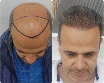 Before and after hair transplant results at Liv Bona Dea Hospital Baku, restored hairline
