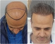 Before and after hair transplant results at Liv Bona Dea Hospital Baku, restored hairline