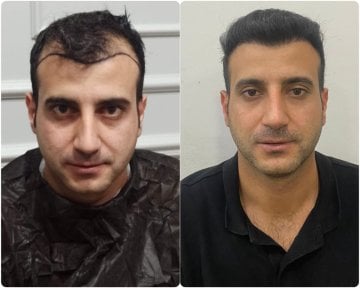 Before and after hair transplant results at Liv Bona Dea Hospital Baku, restored hairline