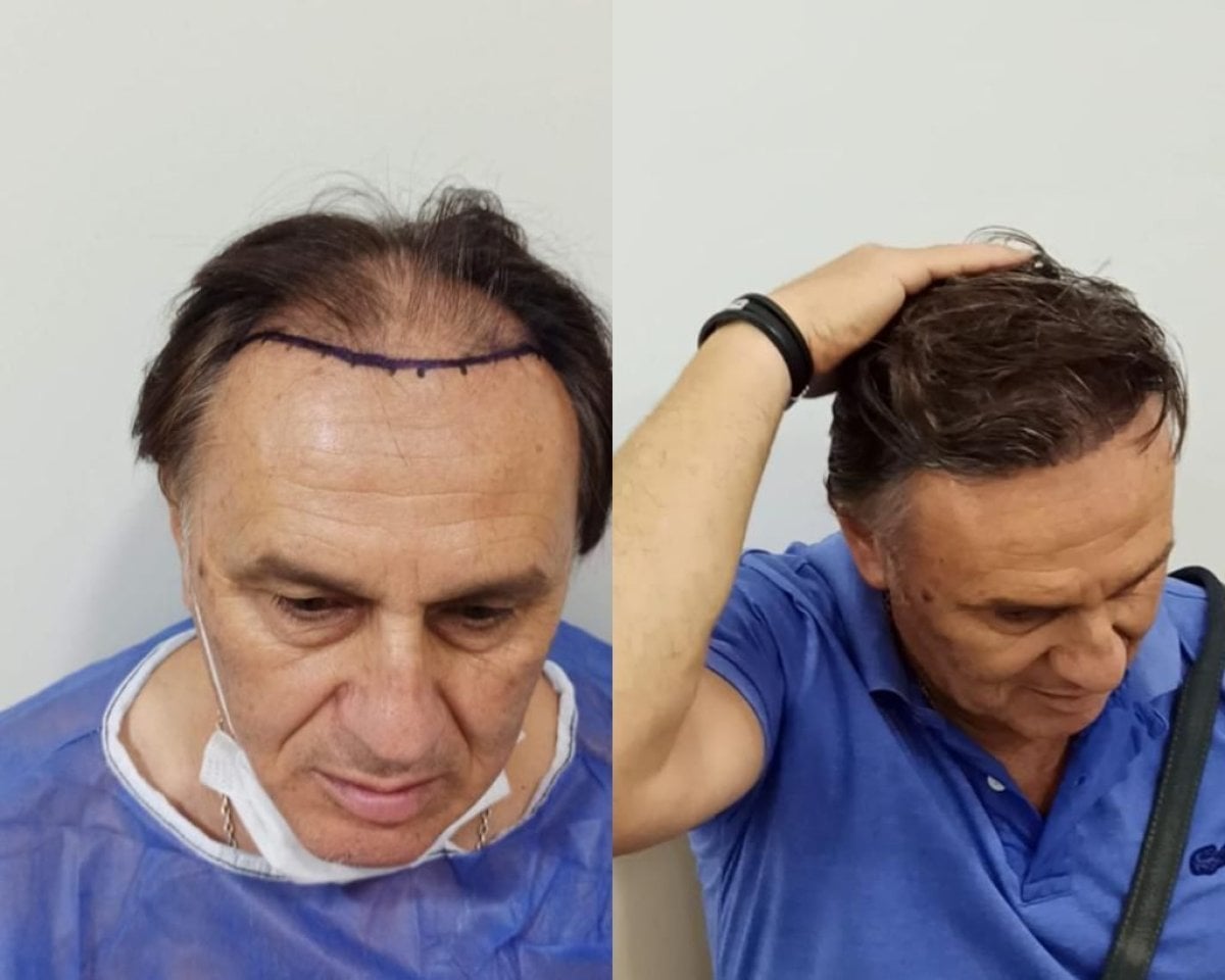 Resultados de trasplante capilar antes y después en Liv Bona Dea Hospital Baku, línea restaurada
