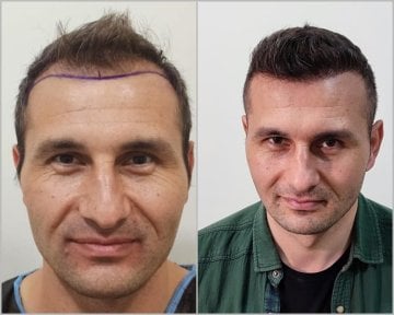 Before and after hair transplant results at Liv Bona Dea Hospital Baku, improved hairline