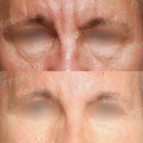 Forehead lift before and after results at Memorial Şişli Hospital, reduced wrinkles and smoother skin