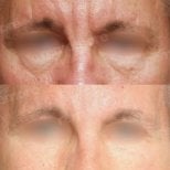 Forehead lift before and after results at Memorial Şişli Hospital, reduced wrinkles and smoother skin