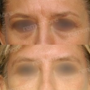 Forehead lift before and after results at Memorial Şişli Hospital, smoother brow appearance