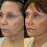 Forehead lift before and after results at Memorial Şişli Hospital, visible facial rejuvenation