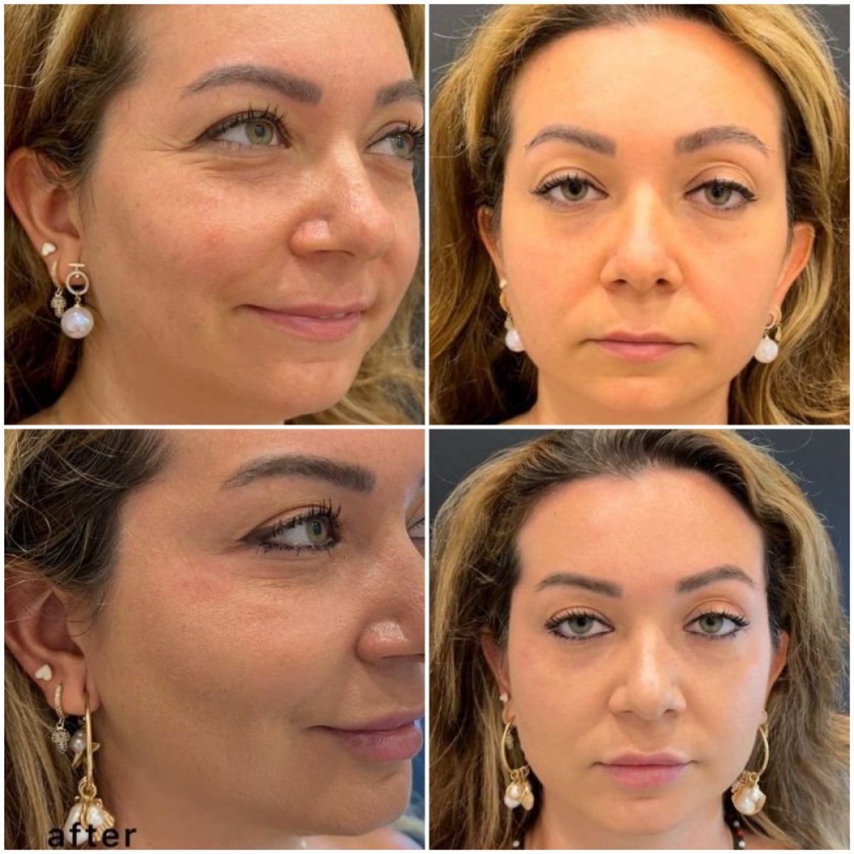 Antes y después de inyecciones de bótox en Liv Bona Dea Hospital Baku, piel facial más suave
