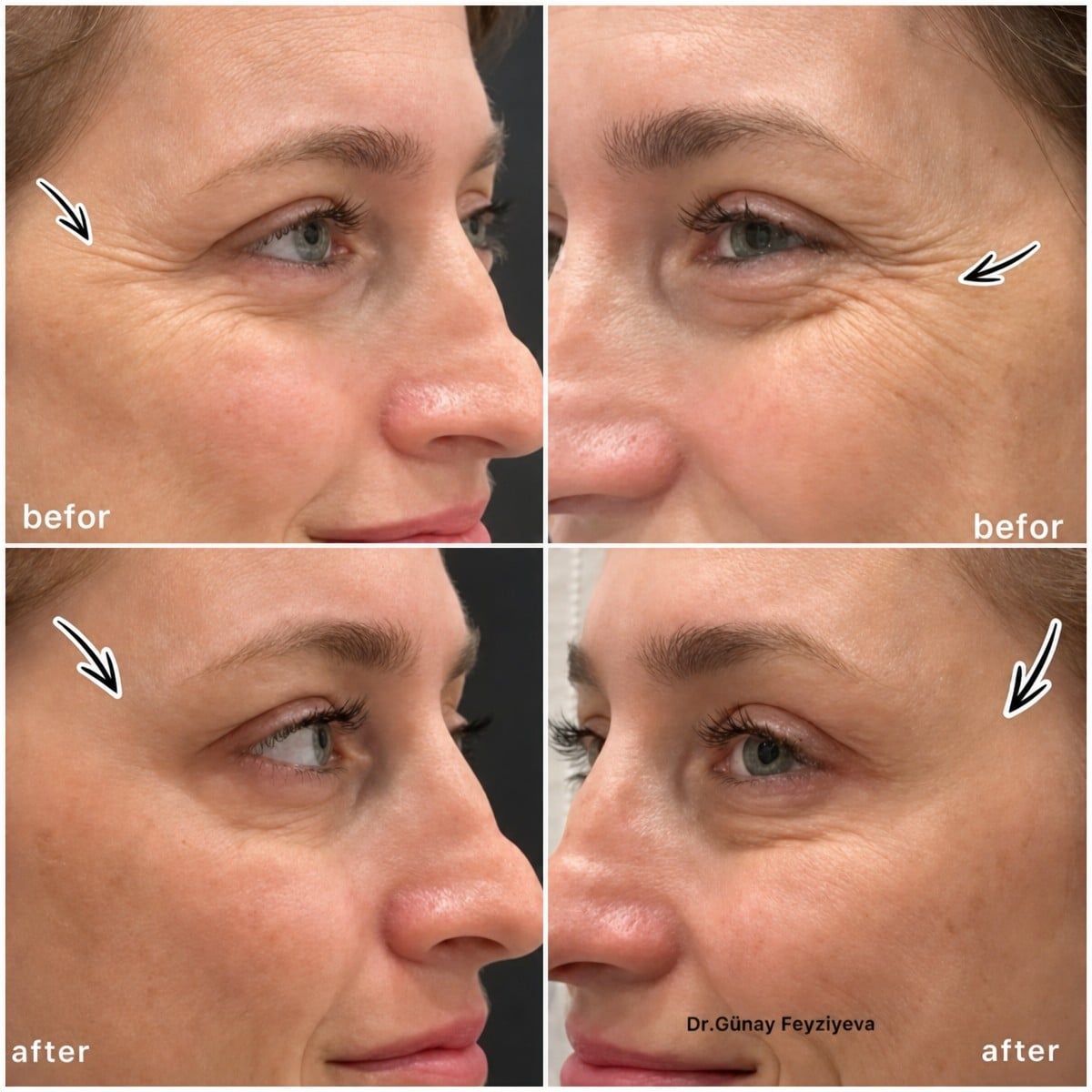 Resultados de inyecciones de botox en Liv Bona Dea Hospital Baku, reducción de arrugas oculares