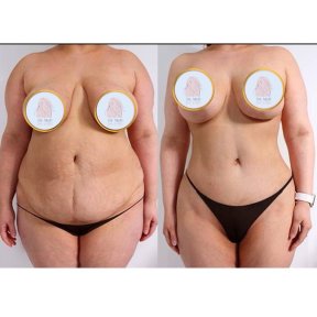 Before and after tummy tuck results at Dr. MED – visible abdominal contour improvement