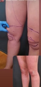 Efekty liposukcji przed i po w Dr. MED – widoczna poprawa konturu ud