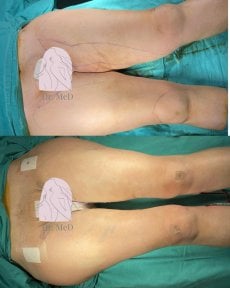 Efekty liposukcji przed i po w Dr. MED, widoczna poprawa konturu ud
