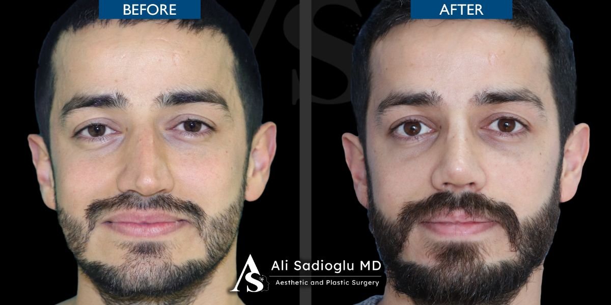 Resultados de rinoplastia antes y después en Dr. Safa Manav Clinic, mejor forma y simetría nasal
