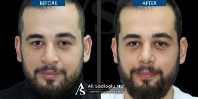 Résultats avant/après rhinoplastie à la clinique Dr. Safa Manav, forme du nez améliorée