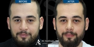 Résultats avant/après rhinoplastie à la clinique Dr. Safa Manav, forme du nez améliorée
