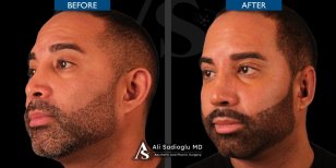 Barttransplantation Vorher-Nachher-Ergebnis bei Dr. Safa Manav Clinic, dichterer Bart