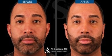 Vorher-nachher-Rhinoplastik-Ergebnis bei Dr. Safa Manav Clinic, verbesserte Nasenform Mann