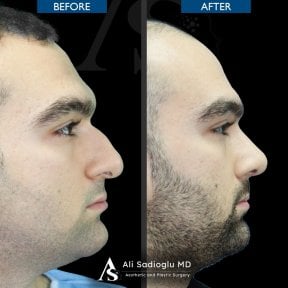 Vorher-nachher-Rhinoplastik-Ergebnisse in der Dr. Safa Manav Klinik, verbesserte Nasenform