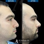 Vorher-nachher-Rhinoplastik-Ergebnisse in der Dr. Safa Manav Klinik, verbesserte Nasenform