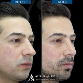 نتائج عملية تجميل الأنف قبل وبعد في عيادة Dr. Safa Manav، تحسين شكل الأنف لدى رجل