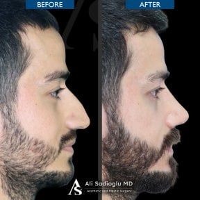 Resultados de rinoplastia antes y después en Dr. Safa Manav Clinic, perfil nasal mejorado