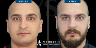 Vorher-nachher-Ergebnis Barttransplantation bei Dr. Safa Manav Clinic, dichterer Bartwuchs